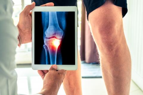 3 mois de traitement par méthotrexate seulement apportent déjà des améliorations significatives de la fonction physique et de l'inflammation chez des patients souffrant d'arthrose du genou primaire (Visuel Adobe Stock 235689003).