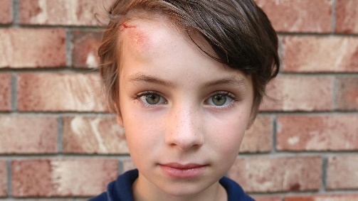 A portrait of a boy with a large lump and cut on his forehead.