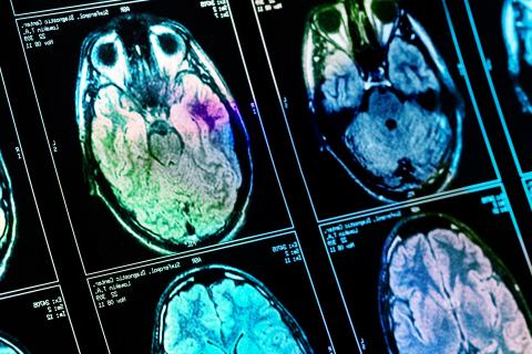 Une seule scintigraphie cérébrale peut permettre de diagnostiquer la maladie d'Alzheimer (Visuel Adobe Stock 171251180)