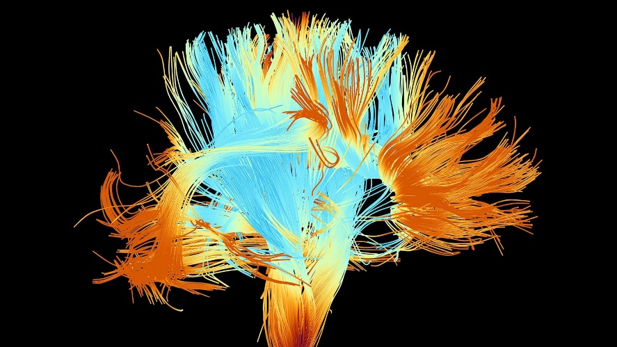  A computer rendering of the white matter fibers of the brain.