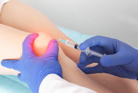 Genoux raides et endoloris ? Arthrose sévère du genou ? Ce « gel de cartilage » qui forme un implant pourrait soulager la douleur liée aux articulations endommagées (Visuel Adobe Stock 410060481).