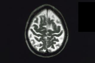 IRM d'un cerveau atteint de la maladie d'Alzheimer.