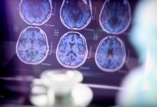 analyse de l'impact de l'Alzheimer sur le cerveau