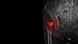 Une radiographie montrant une fracture de la hanche.