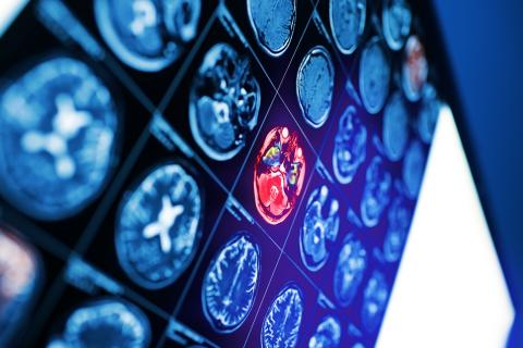 L'âge du cerveau, tel qu’évalué par neuroimagerie, joue un rôle déterminant dans les résultats post-AVC et onstitue un marqueur fiable pour identifier les patients à risque de moins bons résultats (Visuel Adobe Stock 220113313)
